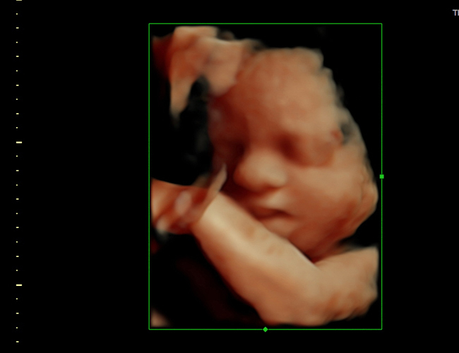 3D ultrasound image at 29 weeks